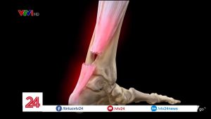 Phục hồi khả năng đi lại cho người bệnh đứt gân gót chân Asin bằng phương pháp Hút áp lực âm (VAC therapy)